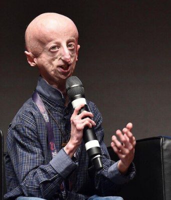 Скончался самый долгоживущий человек с синдромом преждевременного старения