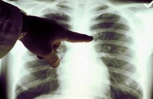 Вакцины от рака скоро начнут испытывать на россиянах