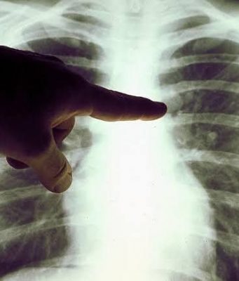 Вакцины от рака скоро начнут испытывать на россиянах