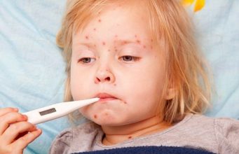 В 2024 году в Молдове зарегистрировали 210 случаев кори