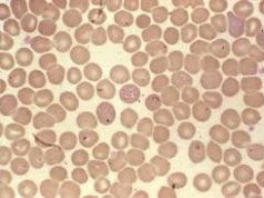 Бабезиоз впервые зафиксирован в Молдове