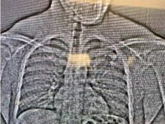 В американском штате Флорида грабитель проглотил бриллиантовые серьги после ограбления бутика