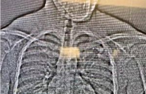 В американском штате Флорида грабитель проглотил бриллиантовые серьги после ограбления бутика