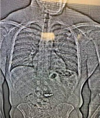 В американском штате Флорида грабитель проглотил бриллиантовые серьги после ограбления бутика