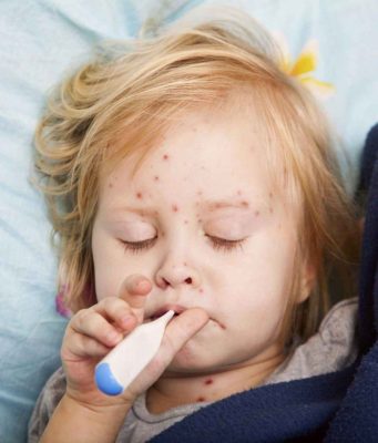 В Кишинёве вспышка кори: 4 подтверждённых случая у невакцинированных детей