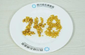 У 26-летнего парня удалили 248 камней из желчного пузыря — он питался жареной курицей, жирным мясом и едой навынос.